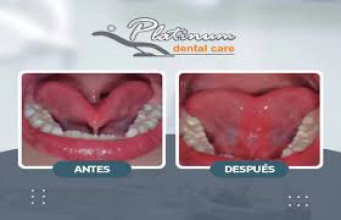 ¡Cirugía de frenillo lingual de 7 años a más! en Platinum Dental