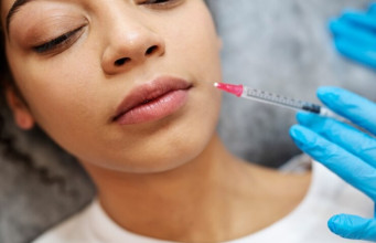 ¡Perfilado o engrosamiento de Labios con Ácido Hialurónico en Armoniza Dent!